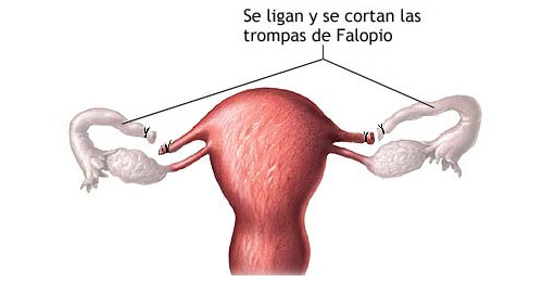 Ligadura de trompas ventajas e inconvenientes